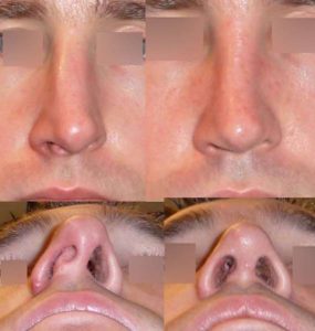 différence entre rhinoplastie et septoplastie 