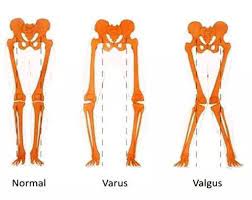 arthrose genou varus valgus