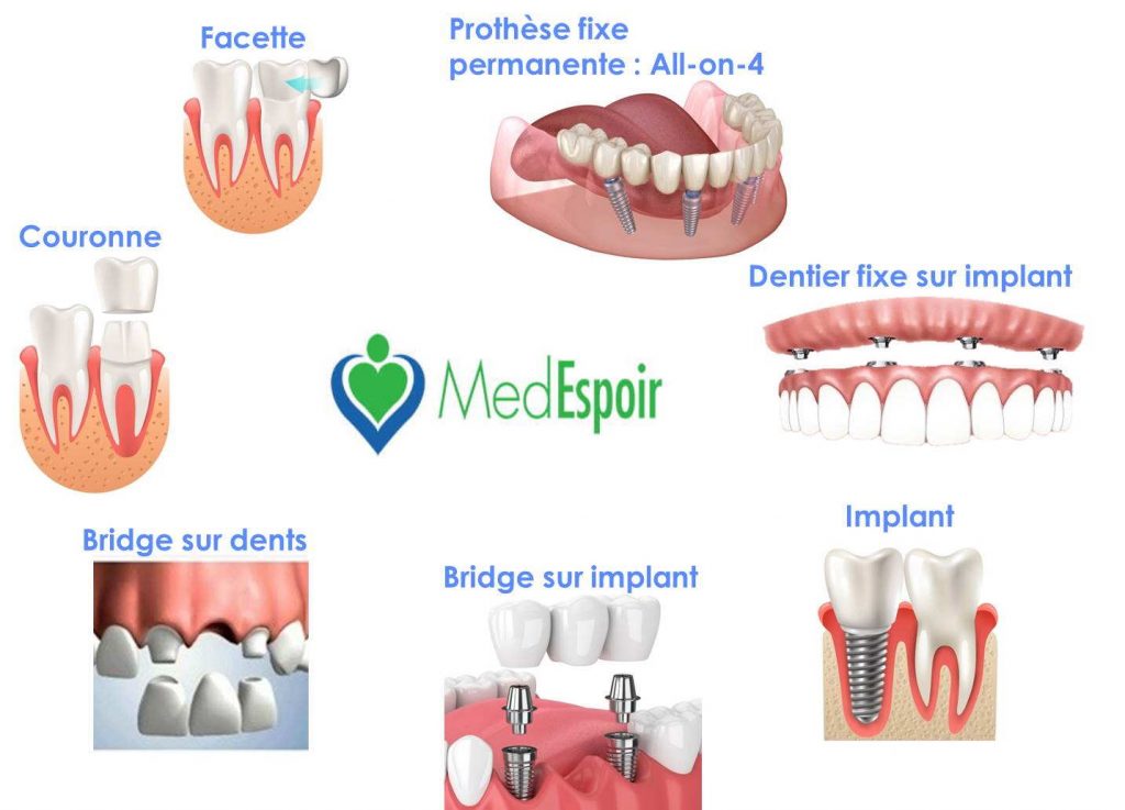 prothèses dentaires maroc