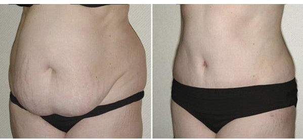 prix abdominoplastie maroc et interventions associées