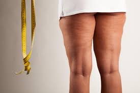 causes types cellulite